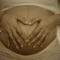 産後の妊娠線
